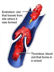 Prevention of Venous Thromboembolism